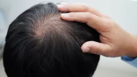 Tratamiento para la calvicie
