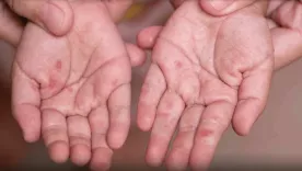 Afectación por virus Coxsackie o Enterovirus A71